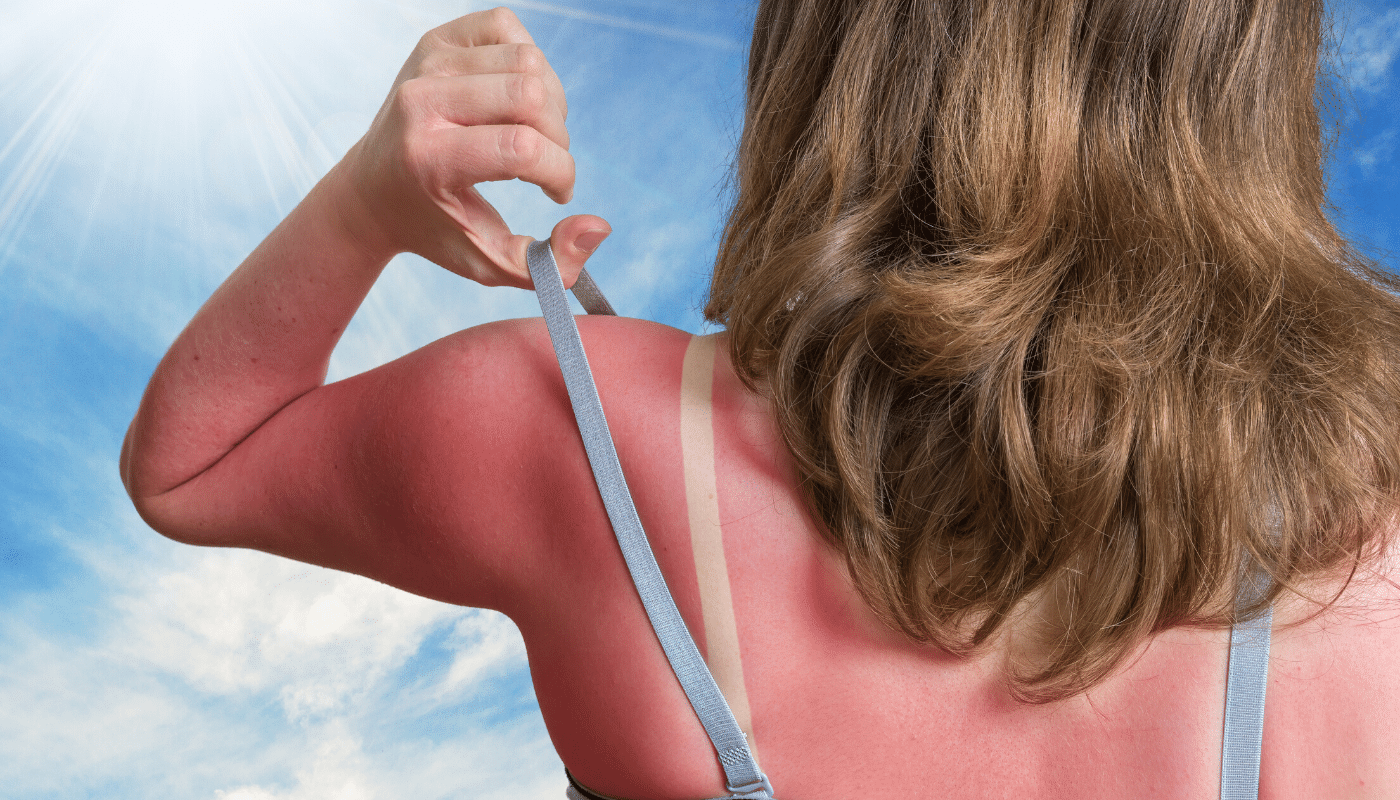 Aloe Vera for Skin Burn & Sunburn Treatment