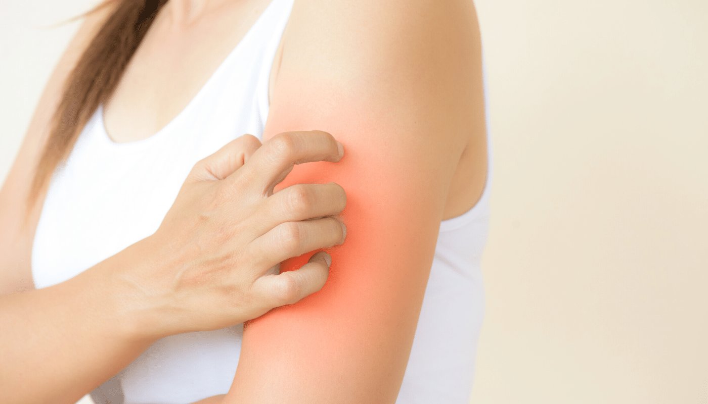 Aloe Vera for your Eczema treatment